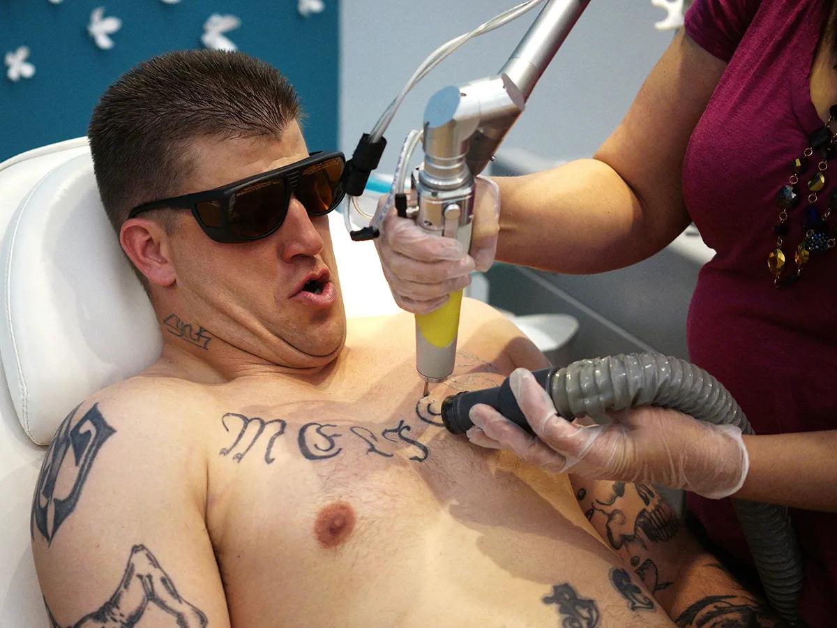 Aftercare for Healthy tattoo removal in Murfreesboro, TN